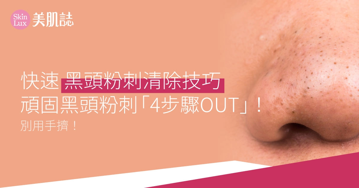 快速黑頭粉刺清除技巧:別用手擠!頑固黑頭粉刺「4步驟OUT」!